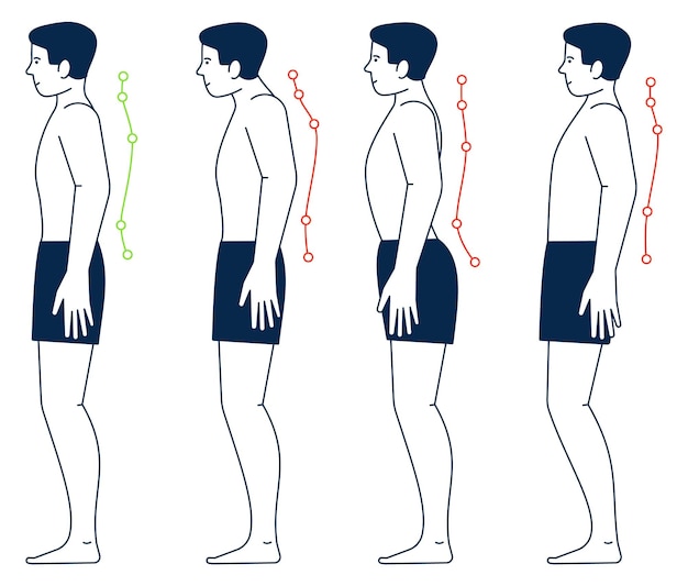 Вектор Мужское тело с правильным и неправильным положением позвоночника положения тела