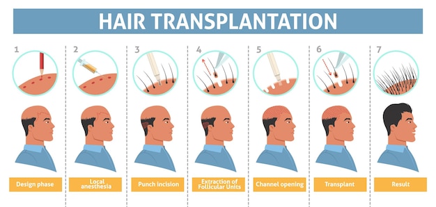 Poster informativo sulla fase del trapianto di capelli di una persona di sesso maschile