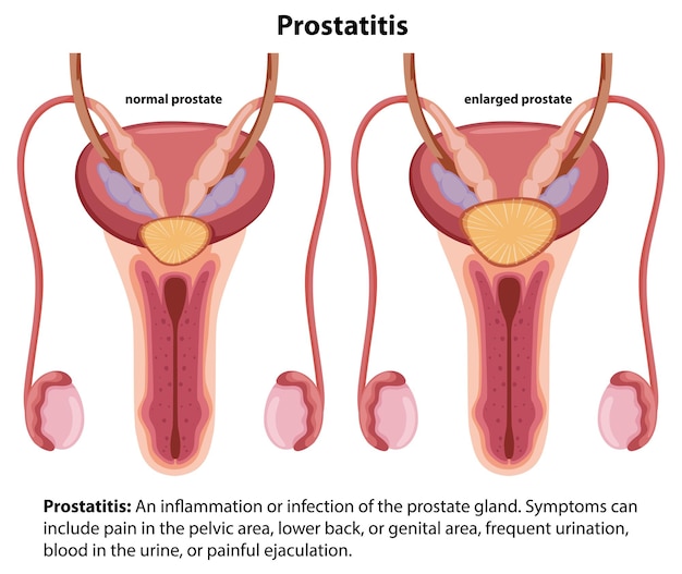 Vector male prostatitis infographic understanding the sickness condition