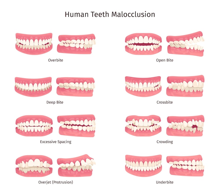Vector malocclusion tooth open bite protruding mouth jaw problem orthodontics infographic overbite underbite human teeth anatomy dental structure dentistry swanky illustration