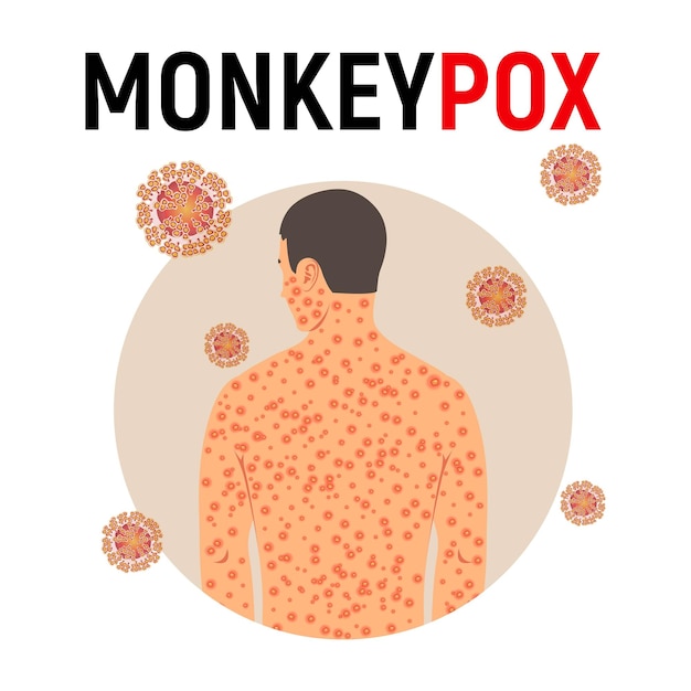 Man sick with monkey smallpox in flat style isolated on white background background with monkey pox