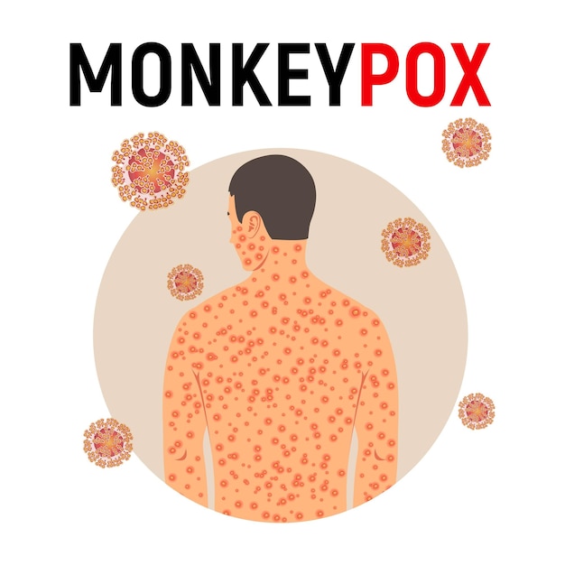 Man sick with monkey smallpox in flat style isolated on white background Background with monkey pox