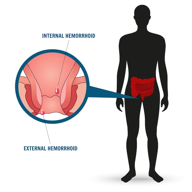 Vector mannequin with hemorrhage disease in vector illustration