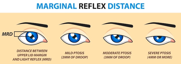 Marginale reflexafstand. Vector illustratie.