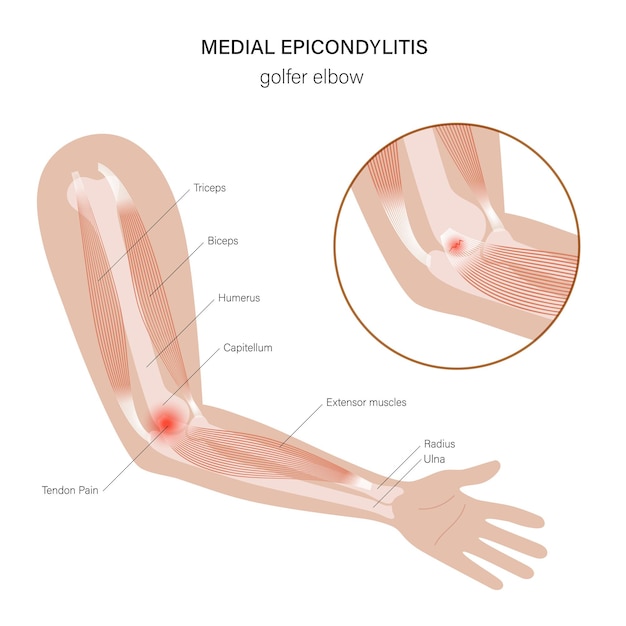 Vector medial epicondylitis golfer elbow