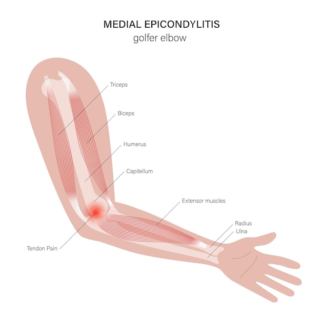 Mediale epicondylitis golferselleboog