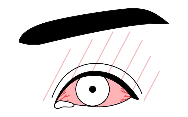 Vector medical clipart line drawing illustration of eye disease and allergic conjunctivitis