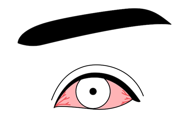 Vector medical clipart line drawing illustration of eye disease and conjunctivitis