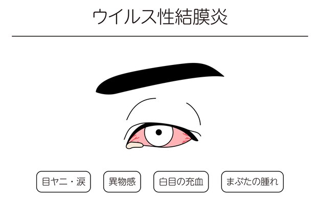 Medical Clipart Line Drawing Illustration of Eye Disease and Viral conjunctivitis