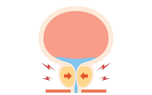 Illustrazione medica di iperplasia prostatica benigna ingrossamento della prostata