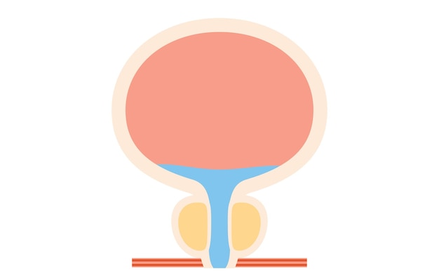 Vector medical illustration of benign prostatic hyperplasia normal prostate