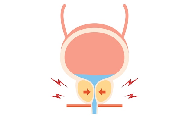 Medical illustration of benign prostatic hyperplasia normal vs enlarged prostate