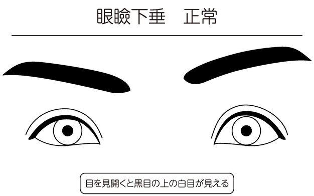 ベクトル 医療イラスト 眼瞼下垂の正常な状態の図