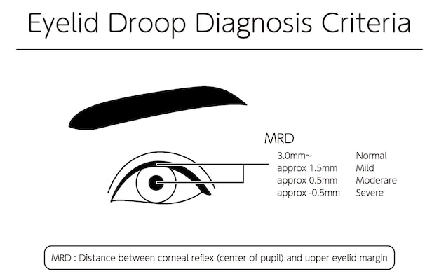 Vector medical illustration diagram of severe ptosis eyelid drooping