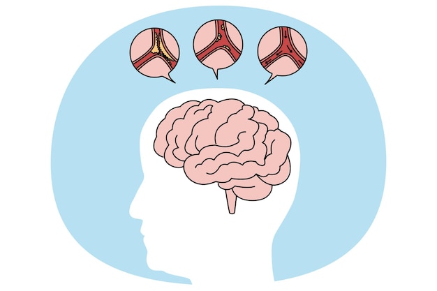 Vector medical illustration of human brain stroke