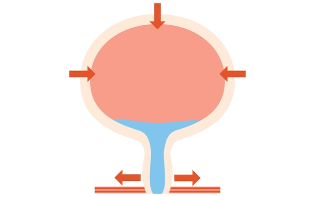 Вектор Медицинская иллюстрация нормального мочевого пузыря, как он мочиться и как он мочится