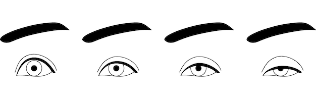 Vector medical illustration ptosis symptoms normal to severe