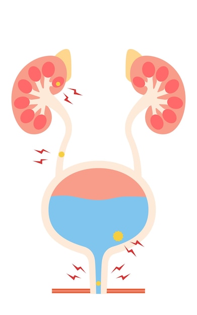 Medical illustration of urinary tract stones kidney stones ureteral stones bladder stones urethral