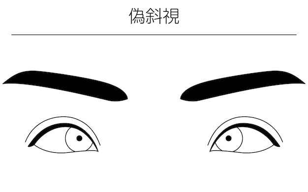 Vector medical illustrations diagrammatic line drawings of eye diseases strabismus and pseudostrabismus