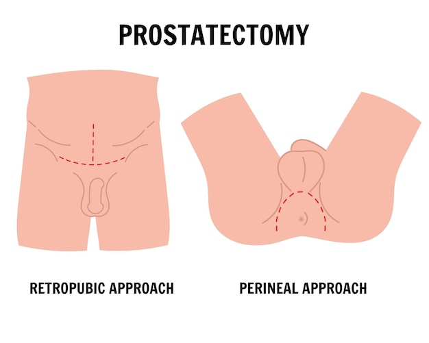 Vector medical infographic of male proctology problem prostatectomy