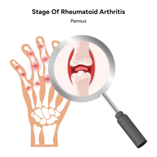 Vector medical infographic stage of rheumatoid arthritis joints bony ankylosis