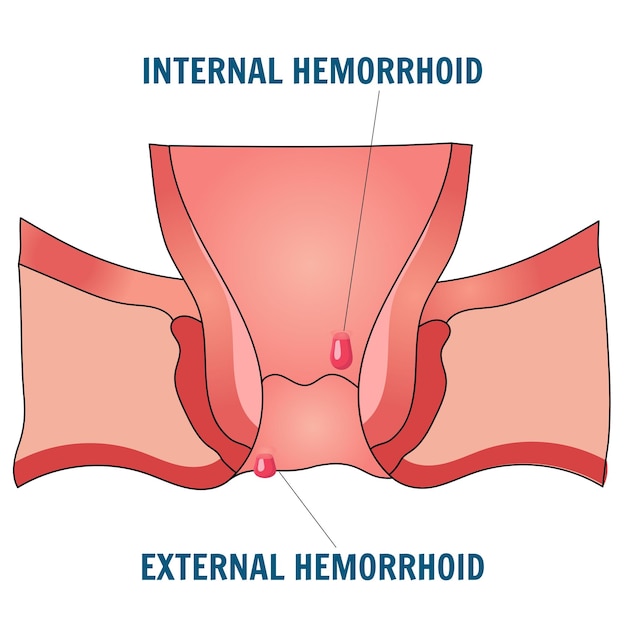 Medical picture of hemorrhage disease in vector illustration