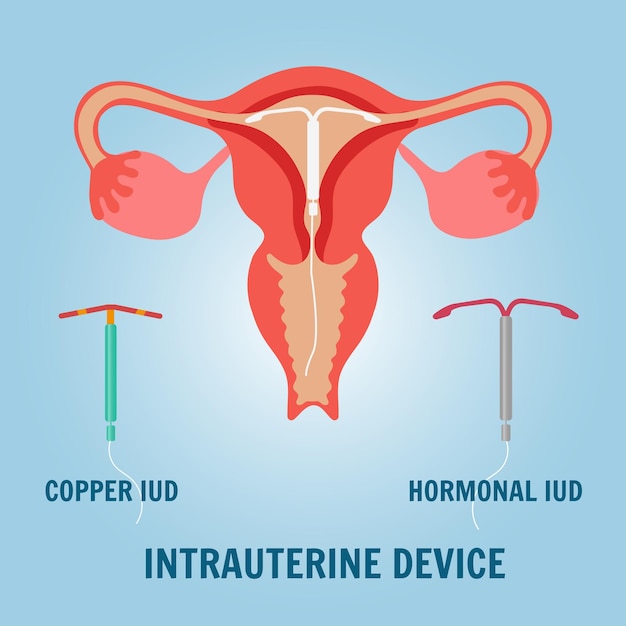 Medical picture of intrauterine devises in female reproductive system in vector illustration