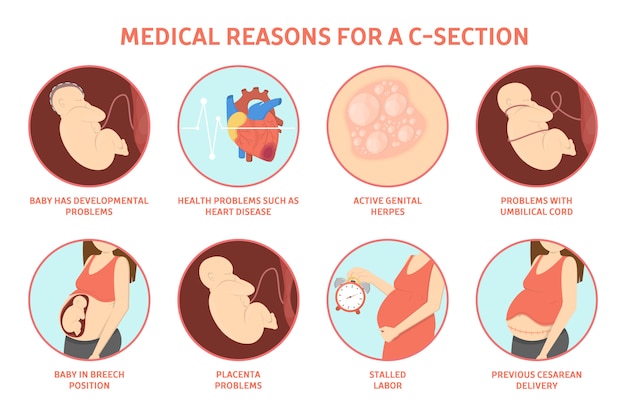 Medical reasons for cesarean delivery or c-section. Medical surgery and abdominal incision. Stalled labor and herpes, problem with placenta.   illustration