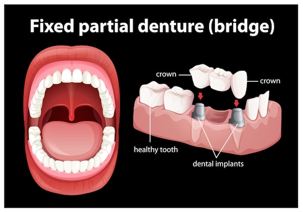 Vector medical vector of fixed partial denture