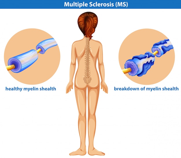 다발성 경화증의 의료 벡터