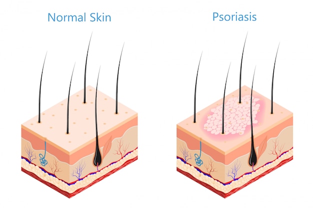 Psoriasi cutanea problematica della medicina