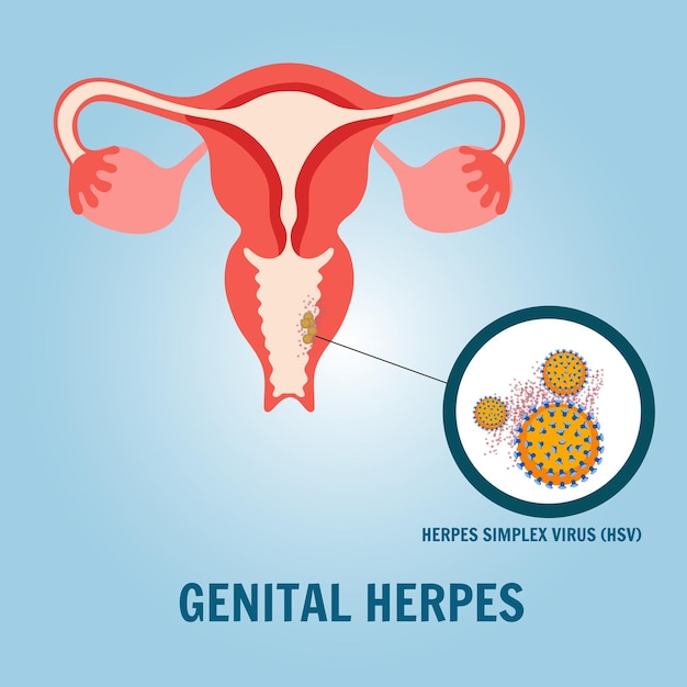 Medische foto genitale herpes in vectorillustratie