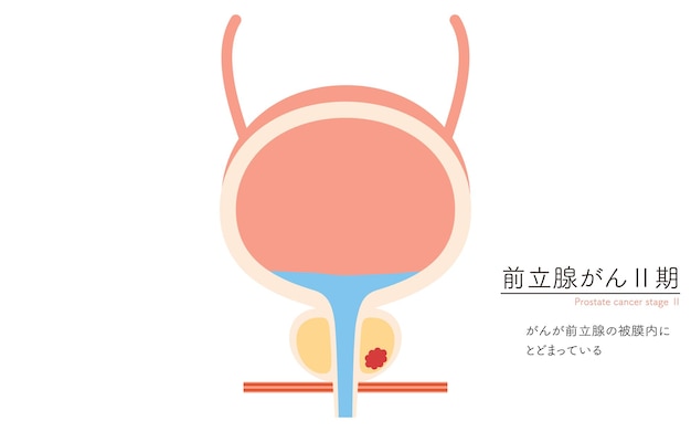 Medische illustratie van prostaatkanker in stadium 2