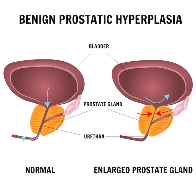 Medische infographic van mannelijk proctologieprobleem dat prostaathyperplasie is