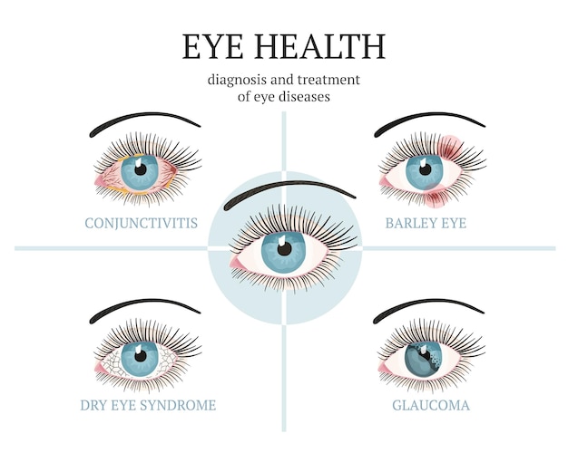 Vector meest voorkomende oogproblemenc conjunctivitis glaucoom droge ogen-syndroom gersteogen