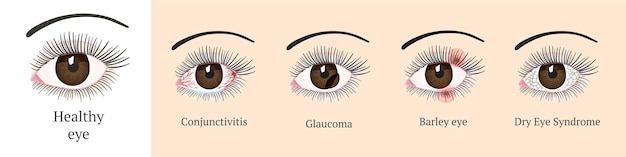 Meest voorkomende oogproblemenc conjunctivitis glaucoom droge ogen-syndroom gersteogen