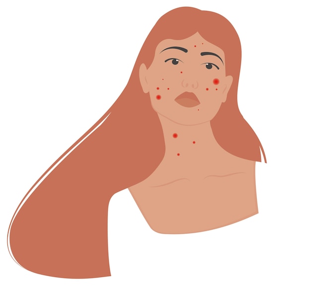 Meisje met acne huidprobleem concept Cartoon scène huidprobleem geïsoleerd op witte achtergrond