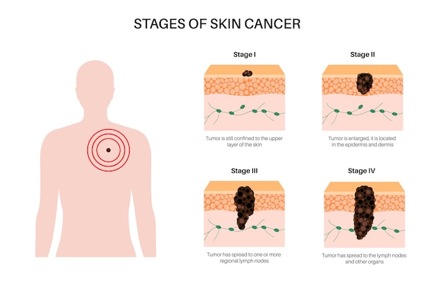 Manifesto delle fasi del melanoma