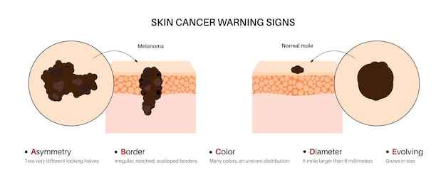 Melanoma warning signs