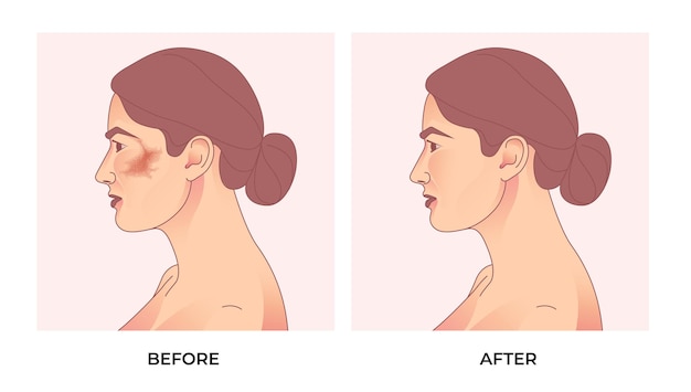 melasma on woman face. before and after melasma pigmentation facial treatment
