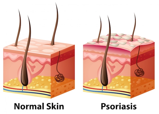 Vector menselijk huiddiagram met normaal en psoriasis