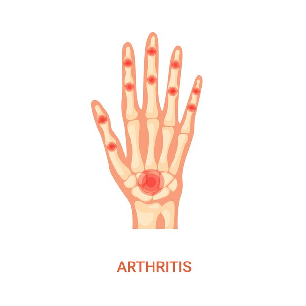 Vector menselijke hand bot artritis ziekte illustratie