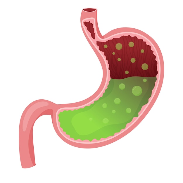 Menselijke maag vol zuur