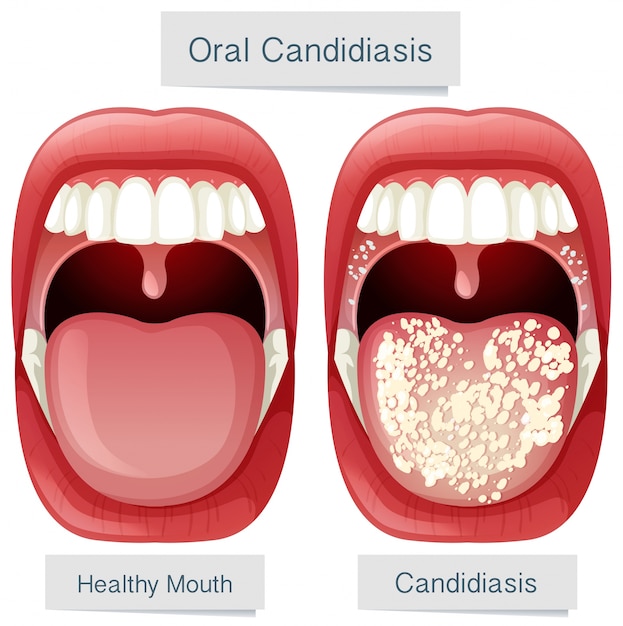 Menselijke mond anatomie orale candidiasis