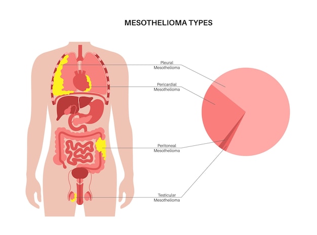 Vector mesothelioma tumor types