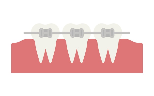 Vettore bretelle metalliche denti ortodontici dentali con parentesi graffe. allineamento del morso dei denti, fila dentale con tutore