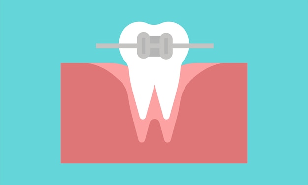 Metalen beugels tandheelkundige orthodontische Tanden met beugels. Uitlijning van tandenbeet, tandrij met beugel