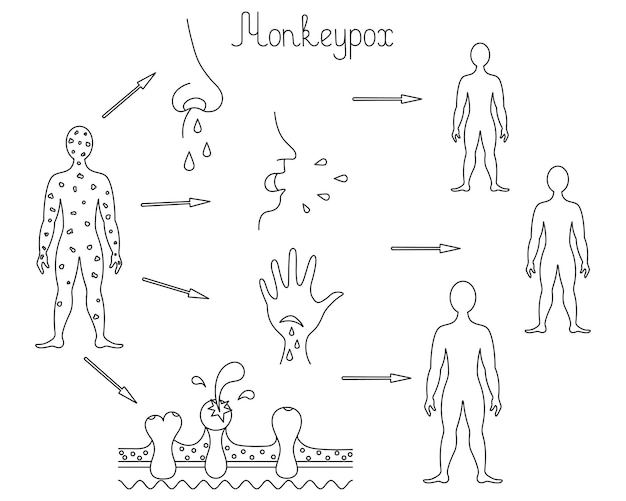 人から人への天然痘のサル痘感染によるヒト感染の方法