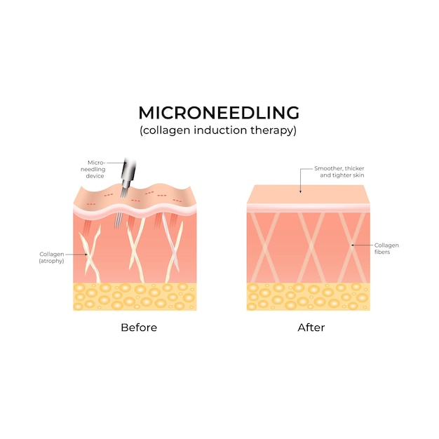 Microneedling Collagen vector illustratie