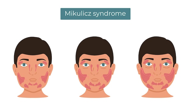 Mikulicz syndrome